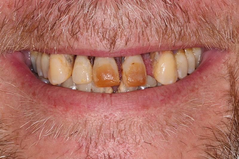 Patient Mike Before Smile