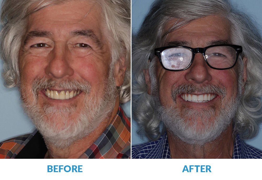 First Patient Before and After Smile Restoration